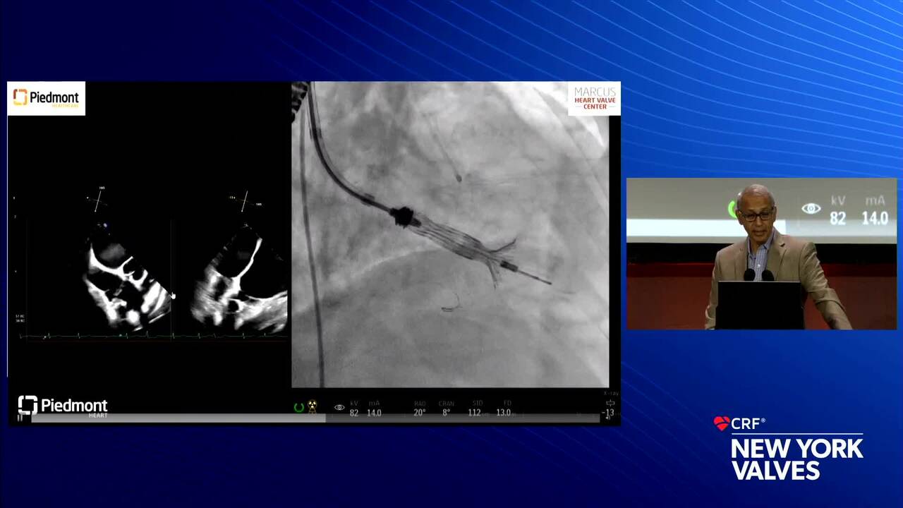 Presentation 1: TRISOL TTVR - Piedmont Heart Institute, Atlanta, GA