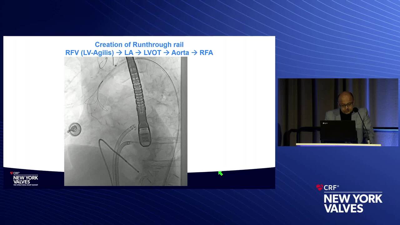 Transcatheter Balloon Expandable Valve in MAC