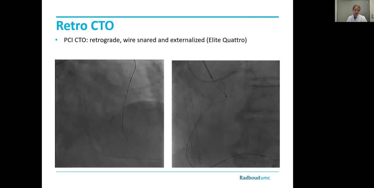 Mechanical Cardiac Support in High-Risk, Complex PCI: Percutaneous Axillary Access for ECMO During Mutli-vessel PCI