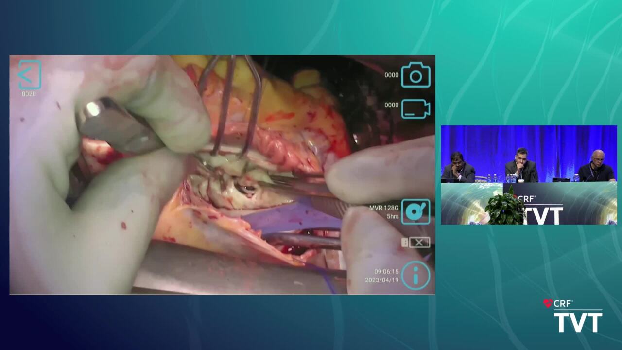 Live Case 22: Surgical Explant of Failed MITRACLIP - Minneapolis Heart Institute - Minneapolis, MN