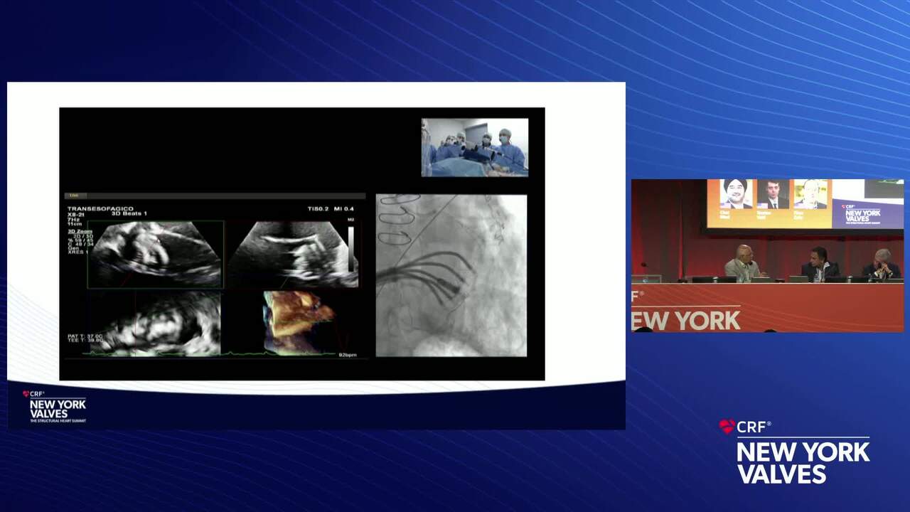 Live Case 19- New TMVR Technology_Live Pre-Recorded Case Presentation 2- Transcatheter Mitral Hemivalve (Polaris) - Instituto do Coração (InCor), University of São Paulo, Sao Paulo, Brazil
