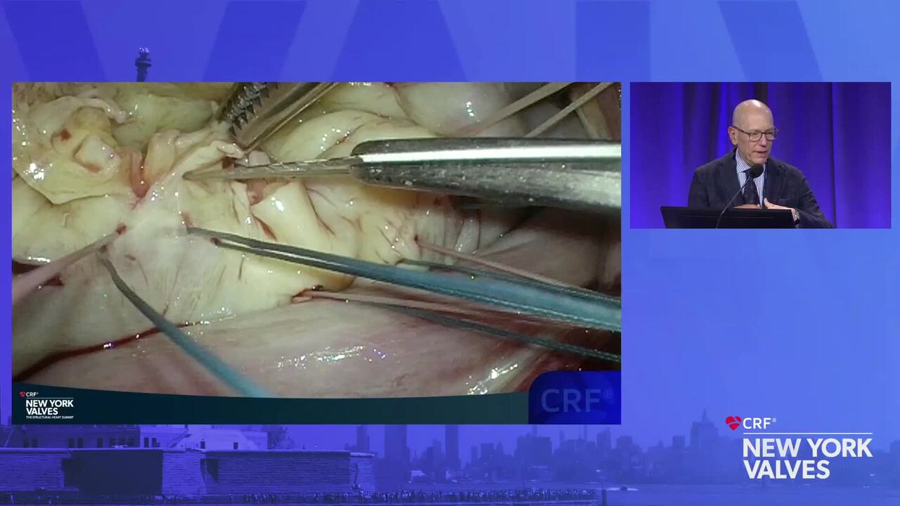 Live Case: Surgical Repair for Primary MR – Mount Sinai Medical Center, New York, NY