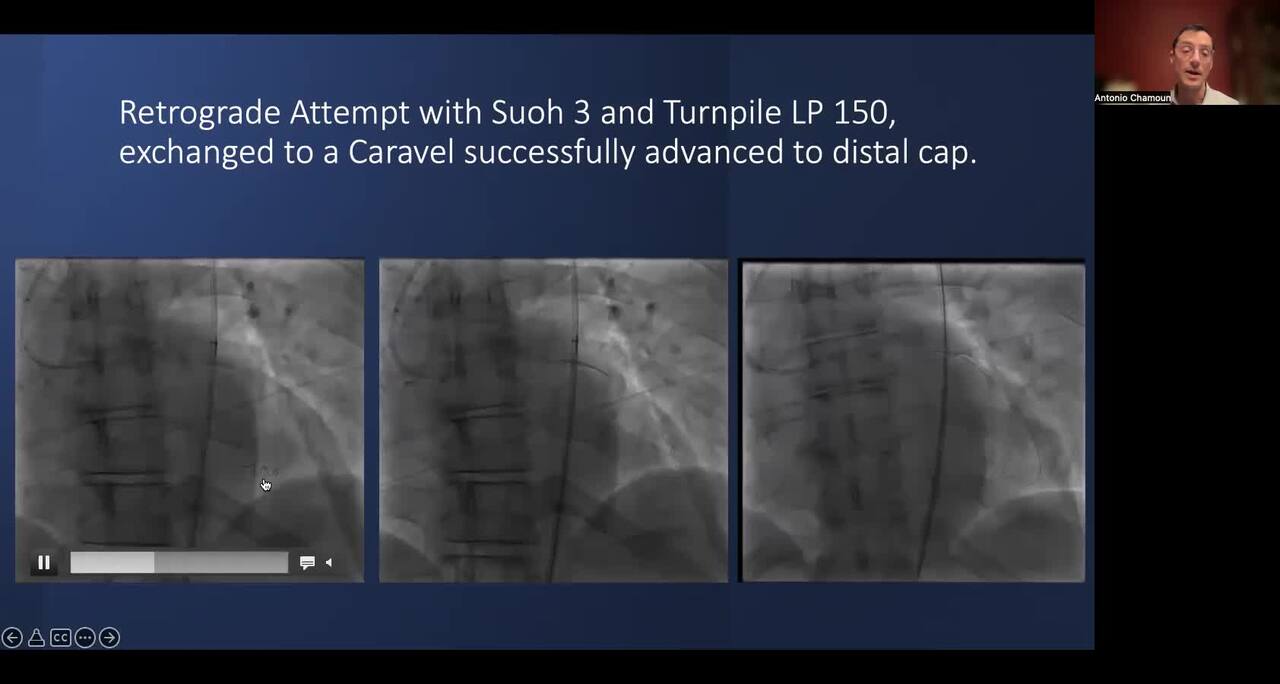 Double Instent CTO of the LCx (Including Flush Ostial LCx CTO)