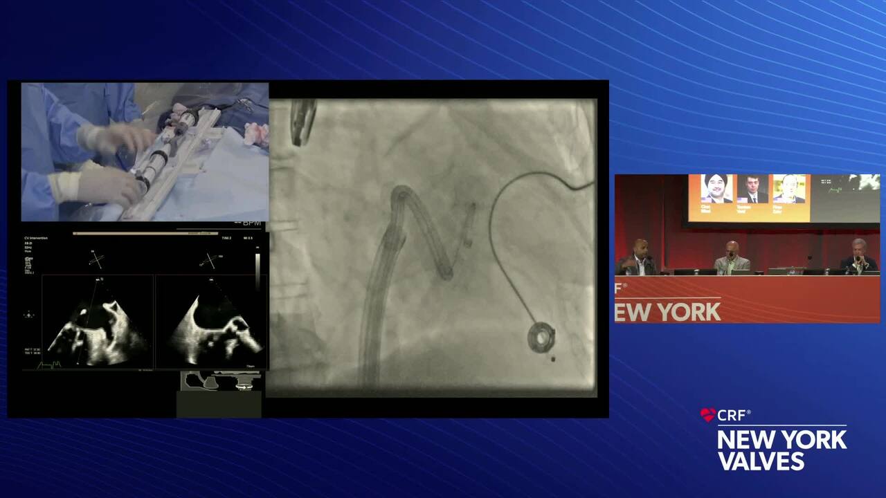 Live Case 19- New TMVR Technology_Live Pre-Recorded Case Presentation 1- TMVR (ENCIRCLE) in Mitraclip Failure - Cedars-Sinai Medical Centeri, Los Angeles, CA