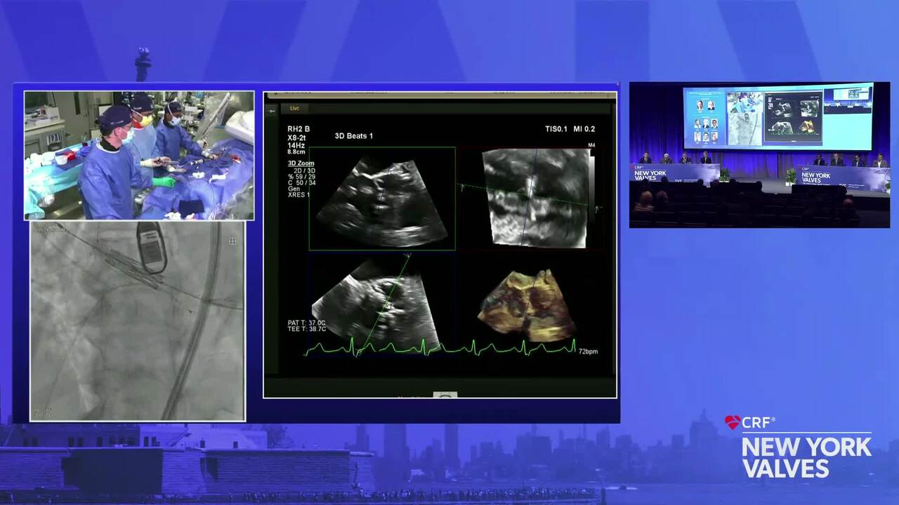 LIVE Case: TAVR in BAVD – NewYork-Presbyterian Columbia University Irving Medical Center, New York, NY