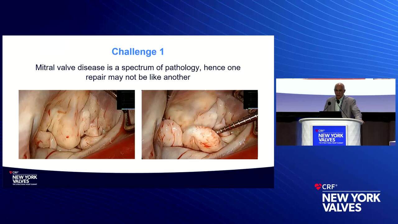 The Reality of MR Recurrence After Surgical Mitral Valve Repair