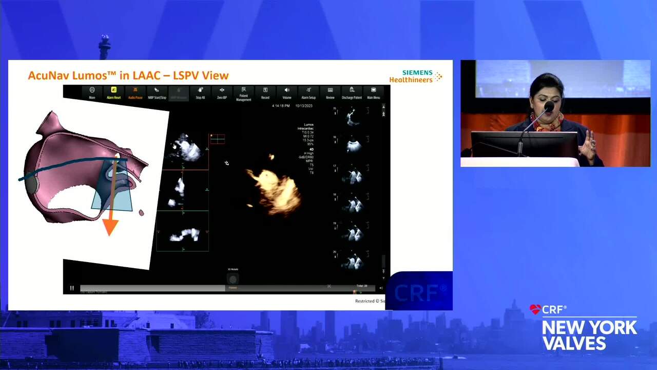 4D ICE imaging of the Left Atrial Appendage and New Frontiers in EP