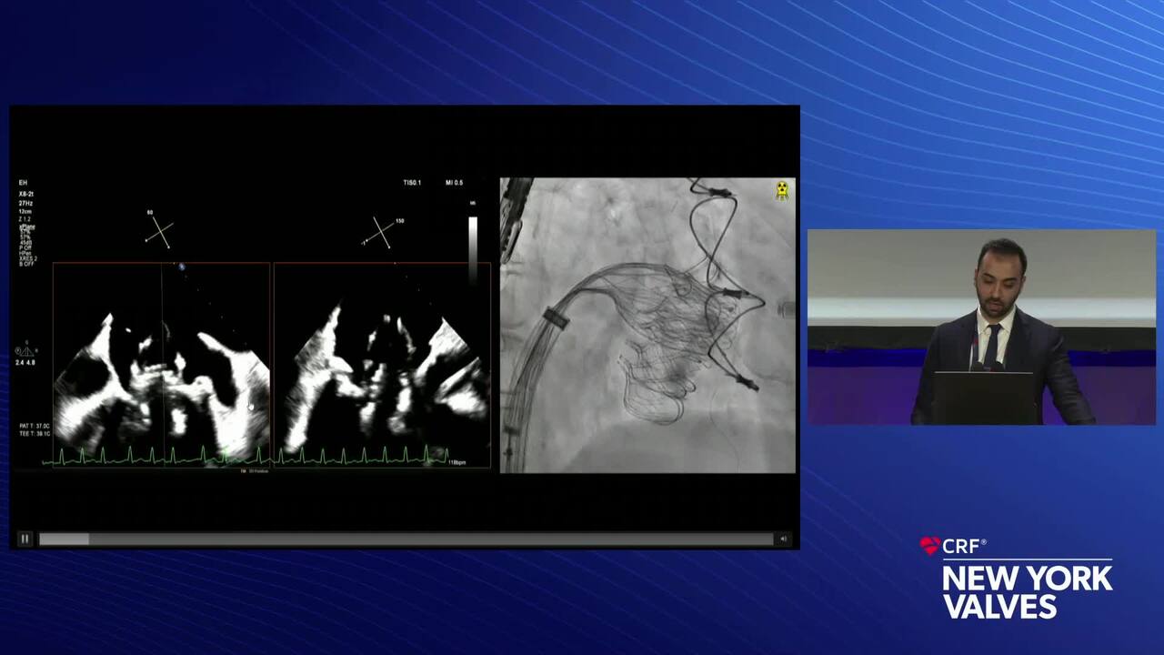 Live Case 14- New TMVR Technology_-Presentation- Alta Valve TMVR - Montefiore Medical Center, New York NY