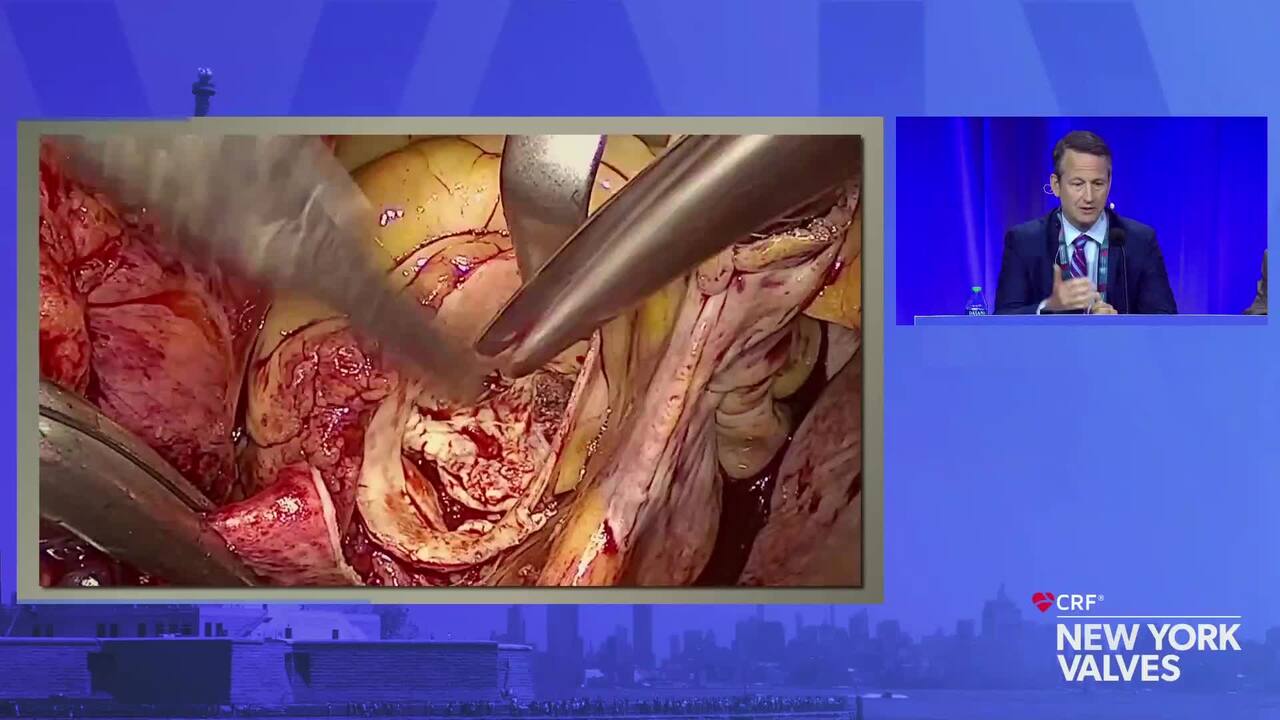 Live Case: Surgery in BAVD – Leipzig Heart Center, Leipzig, Germany