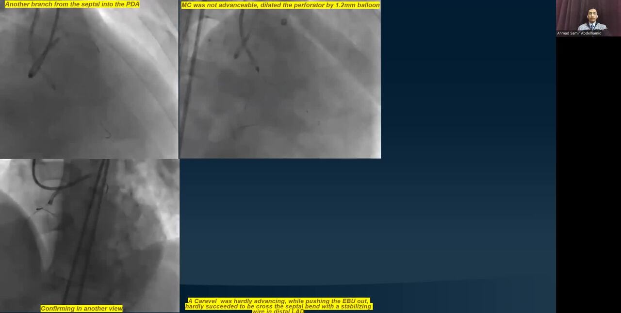The Thorny Road to a Presumably Easy CTO RCA