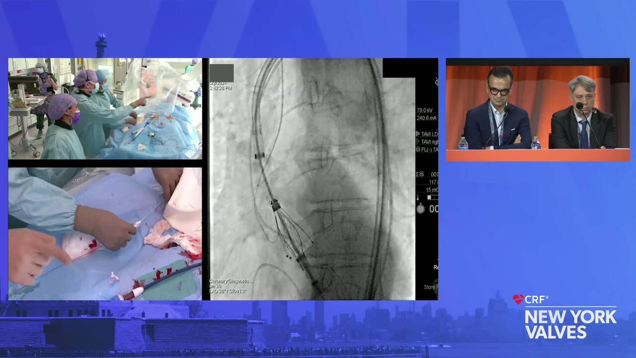 Live Case: TAVR- AR –  The Heart Center, Rigshospitalet, Copenhagen University, Hospital, Copenhagen, Denmark