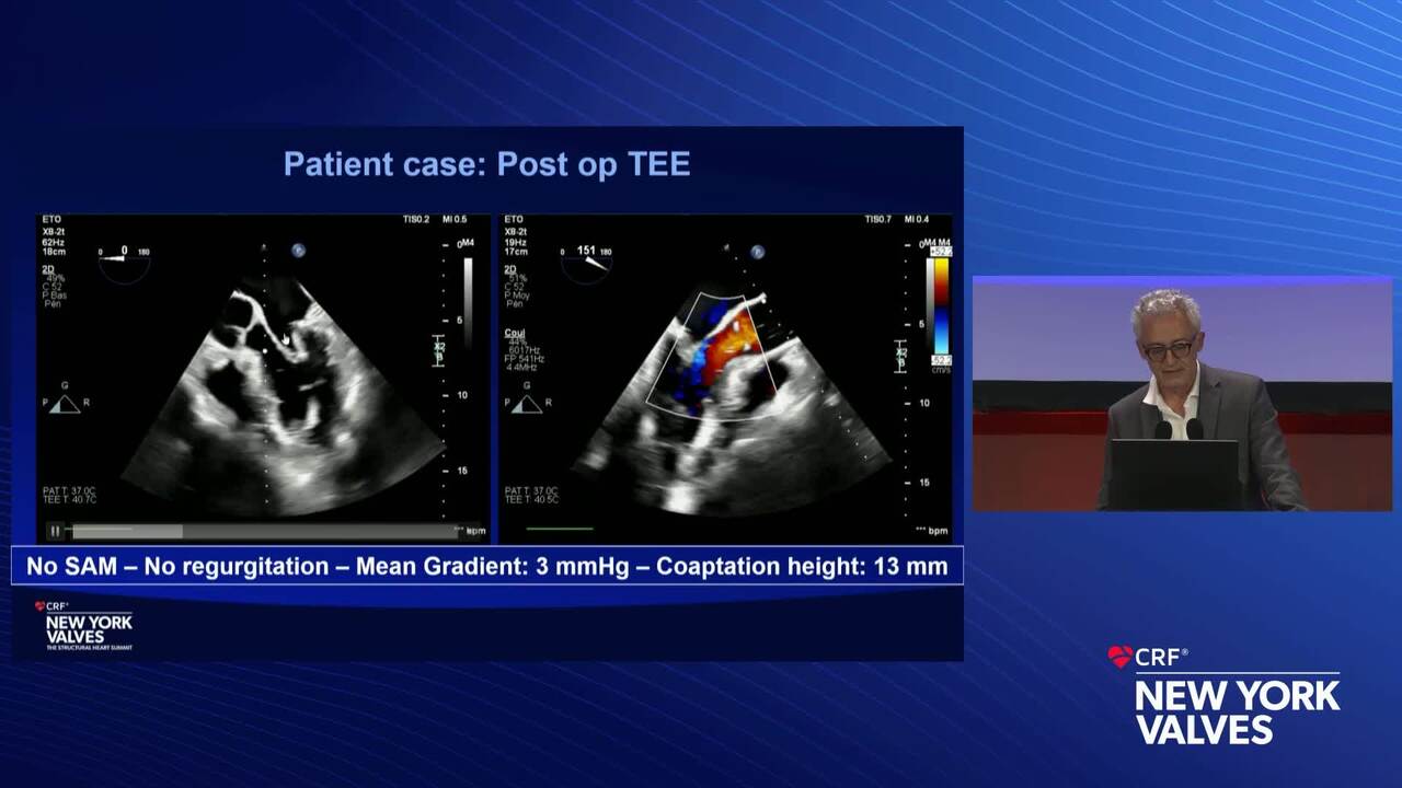 Live Case 20- Complex DMR - Surgical and Transcatheter_-Live Pre-Recorded Case Presentation- Surgical Mitral Repair - Bordeaux University Hospital, Bordeaux, France