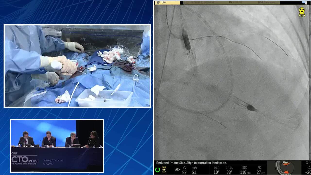 RCA CTO With Ambiguous Proximal Cap and Epicardial Collaterals