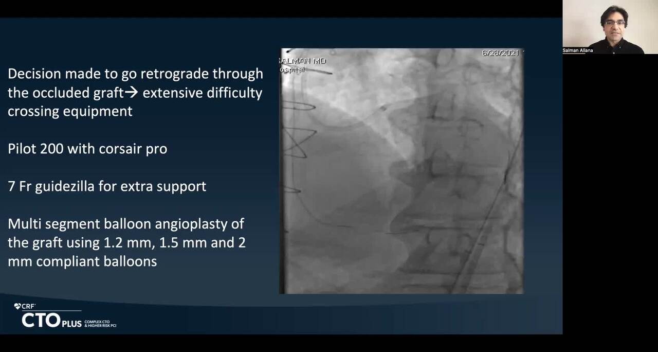 "Energy and Persistence Conquer All Things": A Challenging Case of CTO PCI