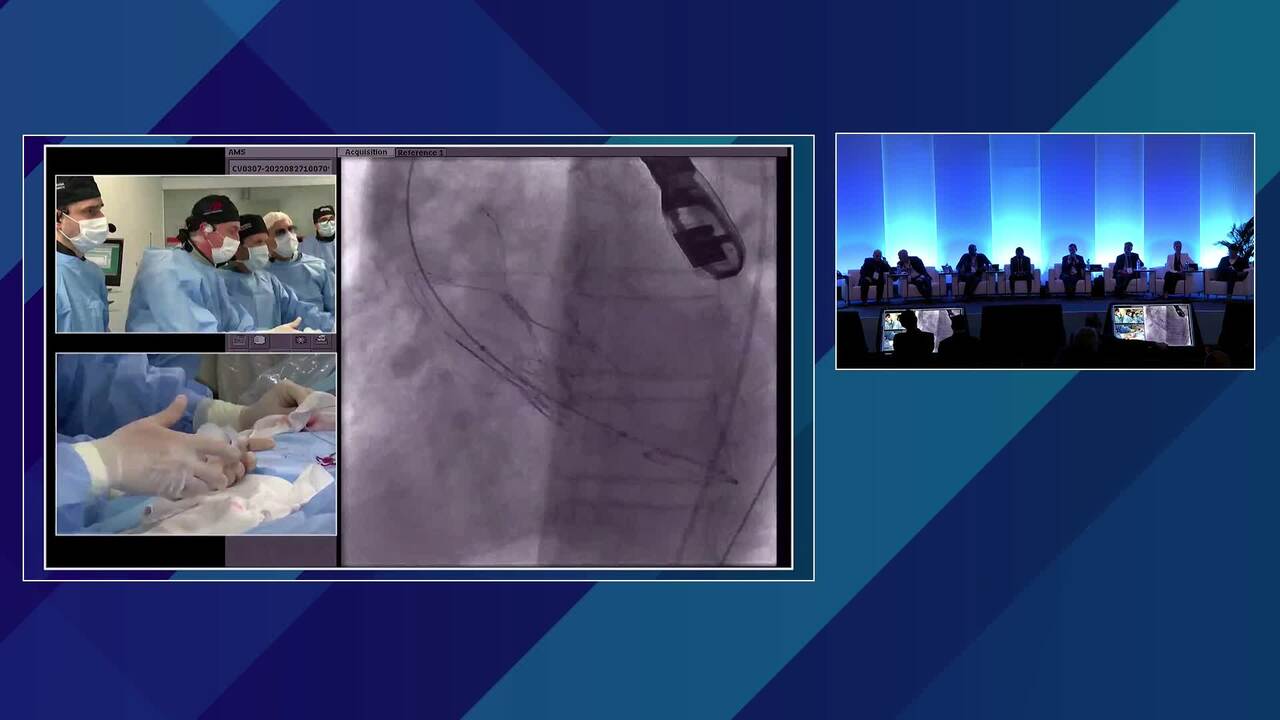 New TAVR Platforms - PORTICO NAVITOR FLEX-NAV