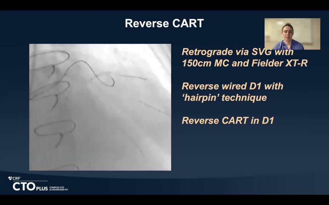 Malignant Vein Graft Aneurysm and Double CTO Post-Bypass