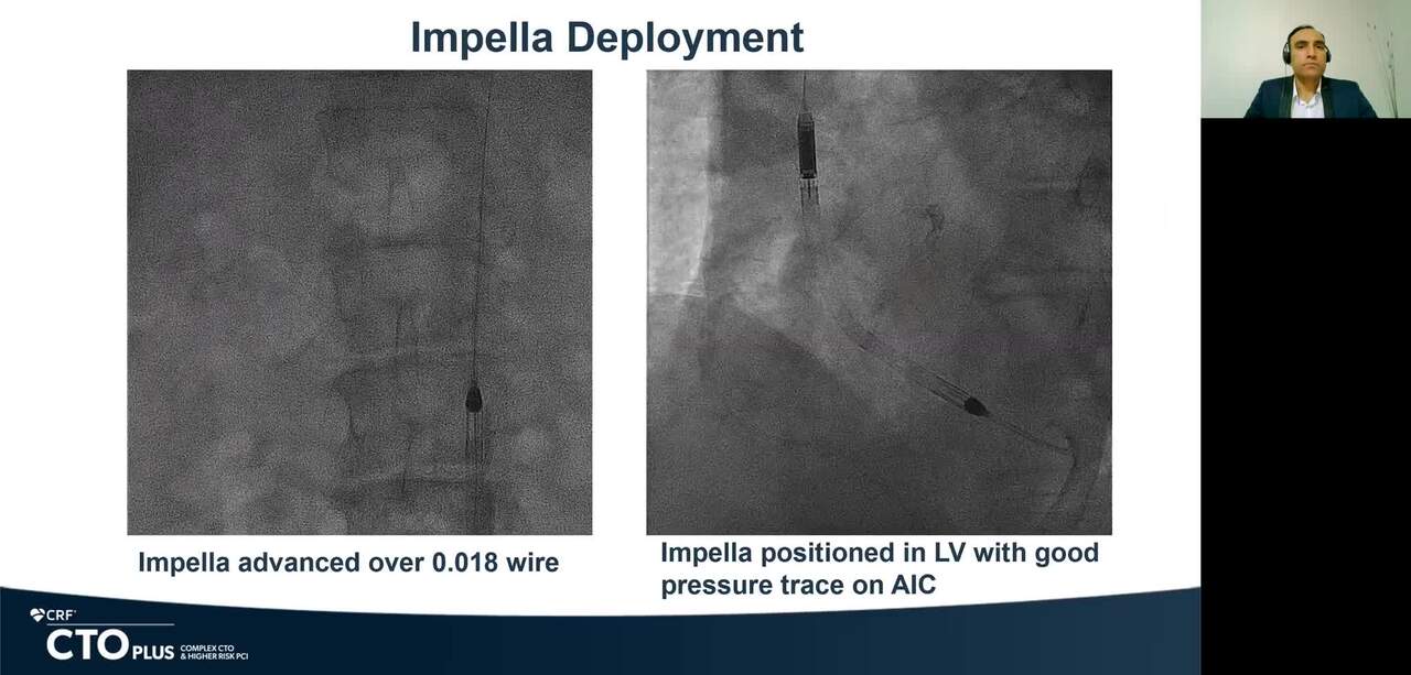 Fixing a Complex and Calcified Lesion With LV Support