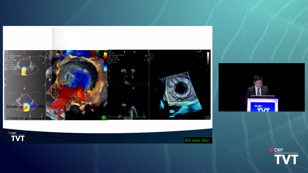 A Transcatheter Mitral Valve-in-Valve Replacement In Failed Bioprosthetic Surgical Valve: A Promising Approach