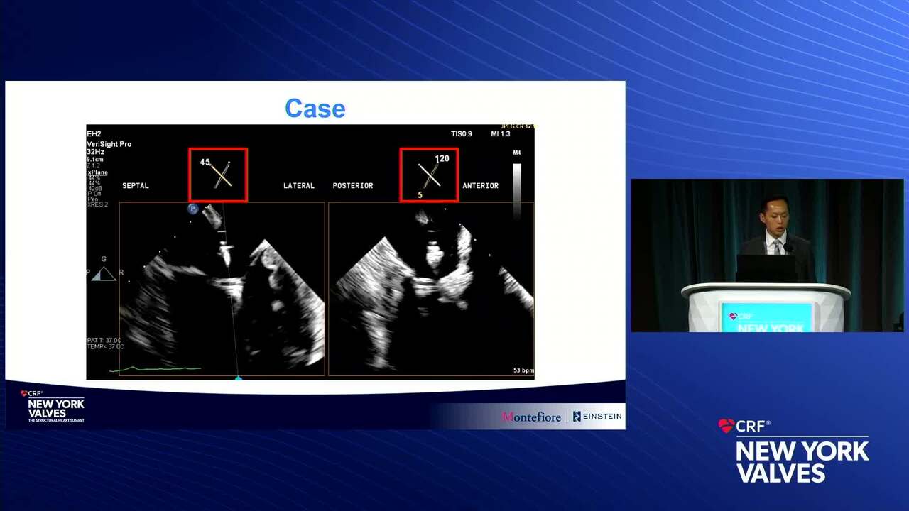 Case: 3D ICE for M-TEER and TMVR