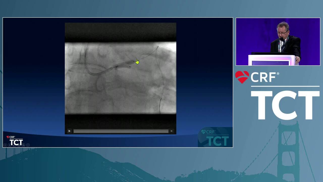 How to Treat a Bifurcation Provisionally: Current Best Practice