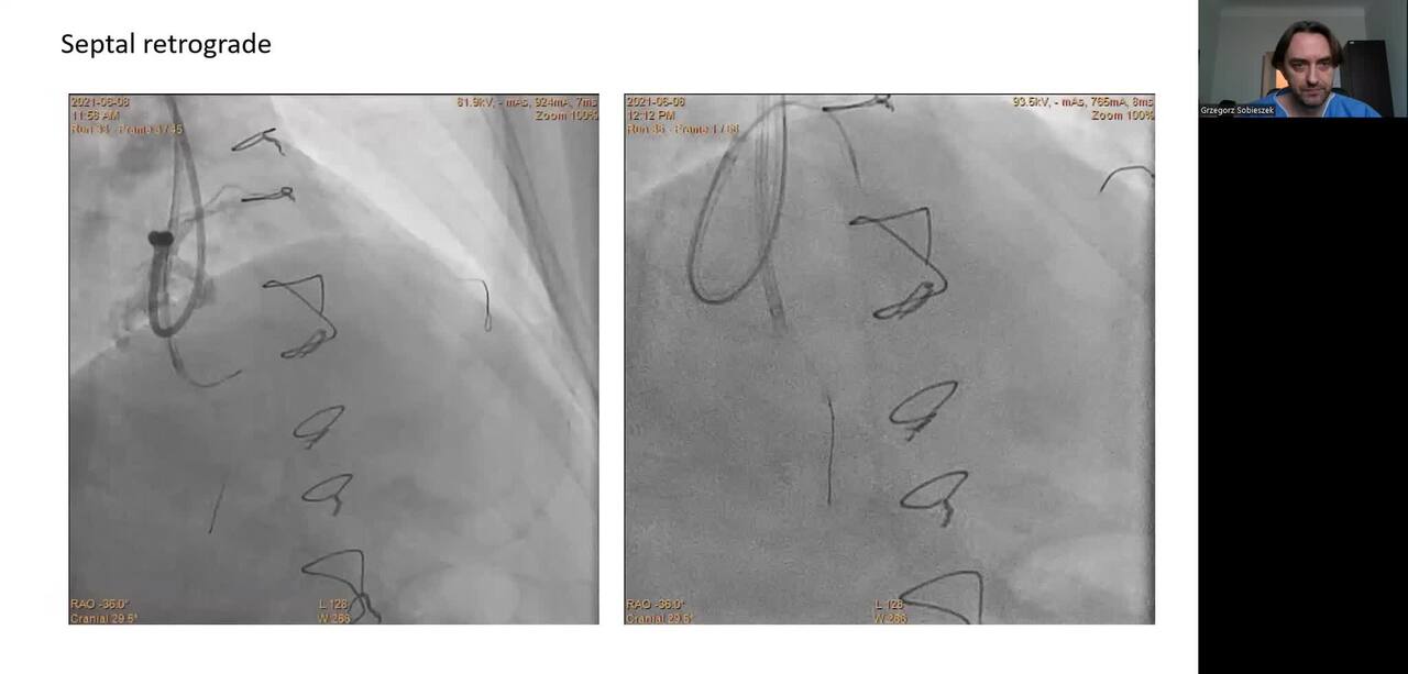 External Crush in CTO RCA
