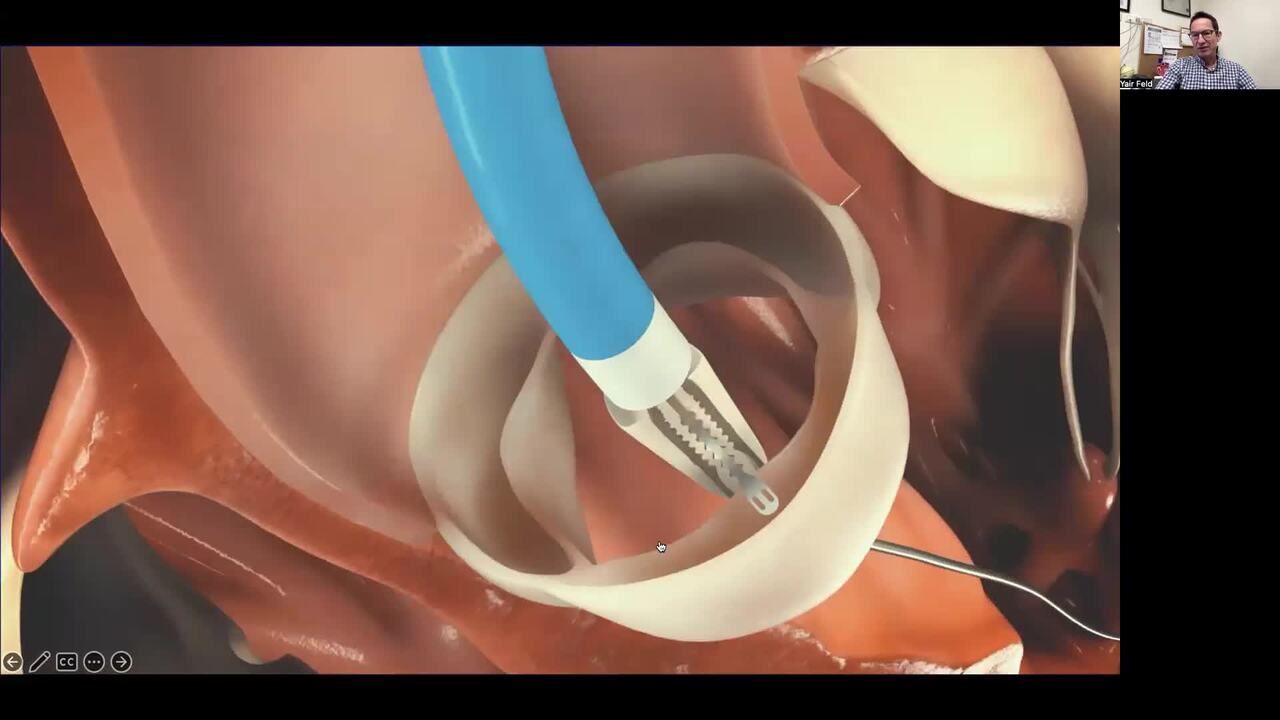 Transcatheter Aortic Valve Repair for Aortic Insufficiency Using the Cusper Device