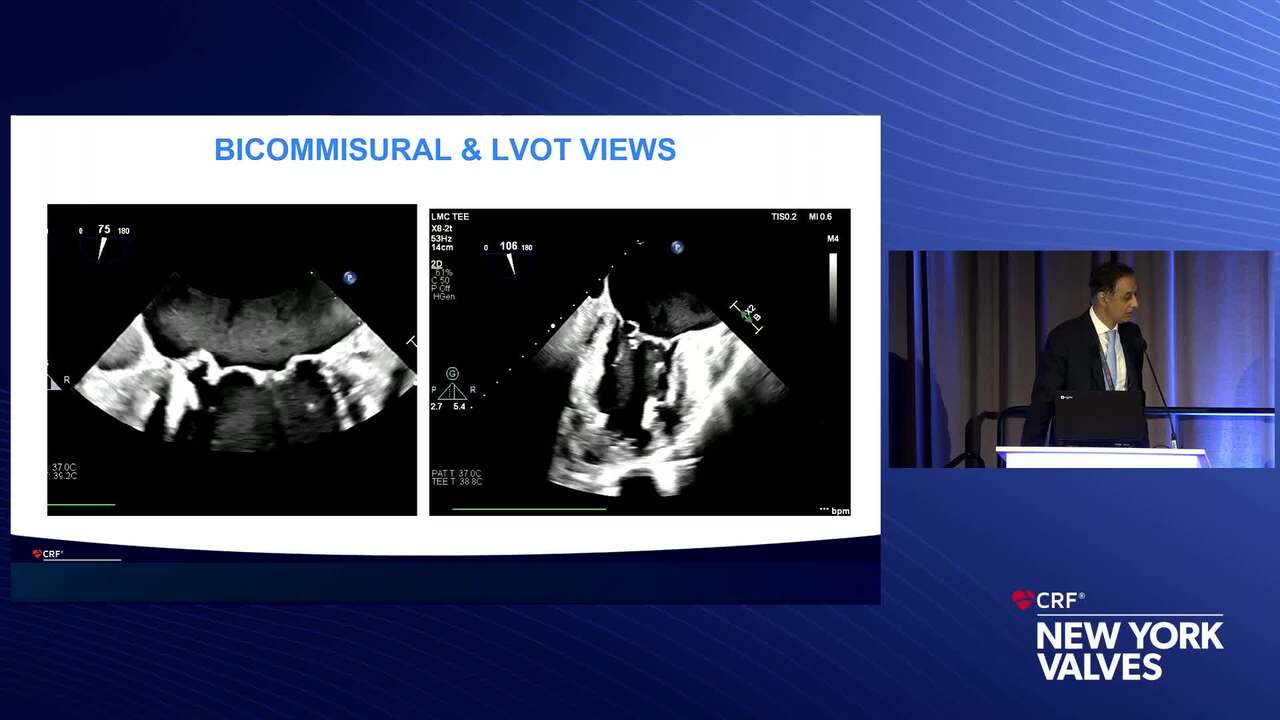 Mitral TEER in Multiple Regurgitant Jets: Case Presentation