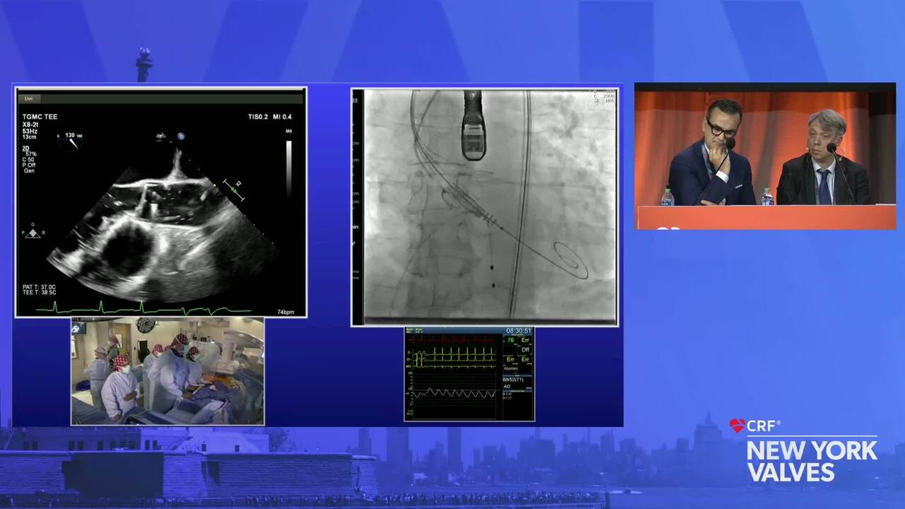 Live Case: AR TAVR - Cardiovascular Institute of the South (CVIS), Houma, LA