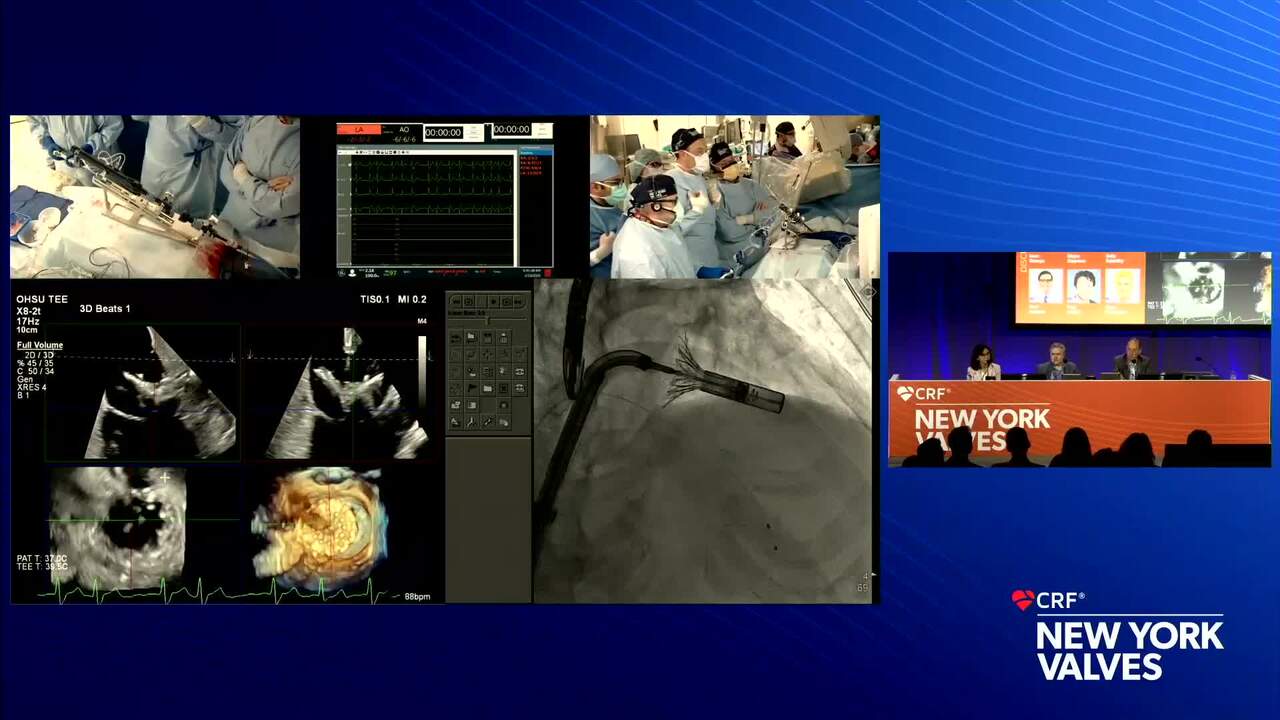 Live Pre-Recorded Case Presentation: Tioga TMVR - Tbilisi Heart and Vascular Clinic, Tbilisi, Georgia