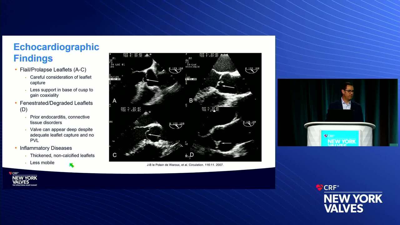Precedural Planning of TAVR for Aortic Regurgitation