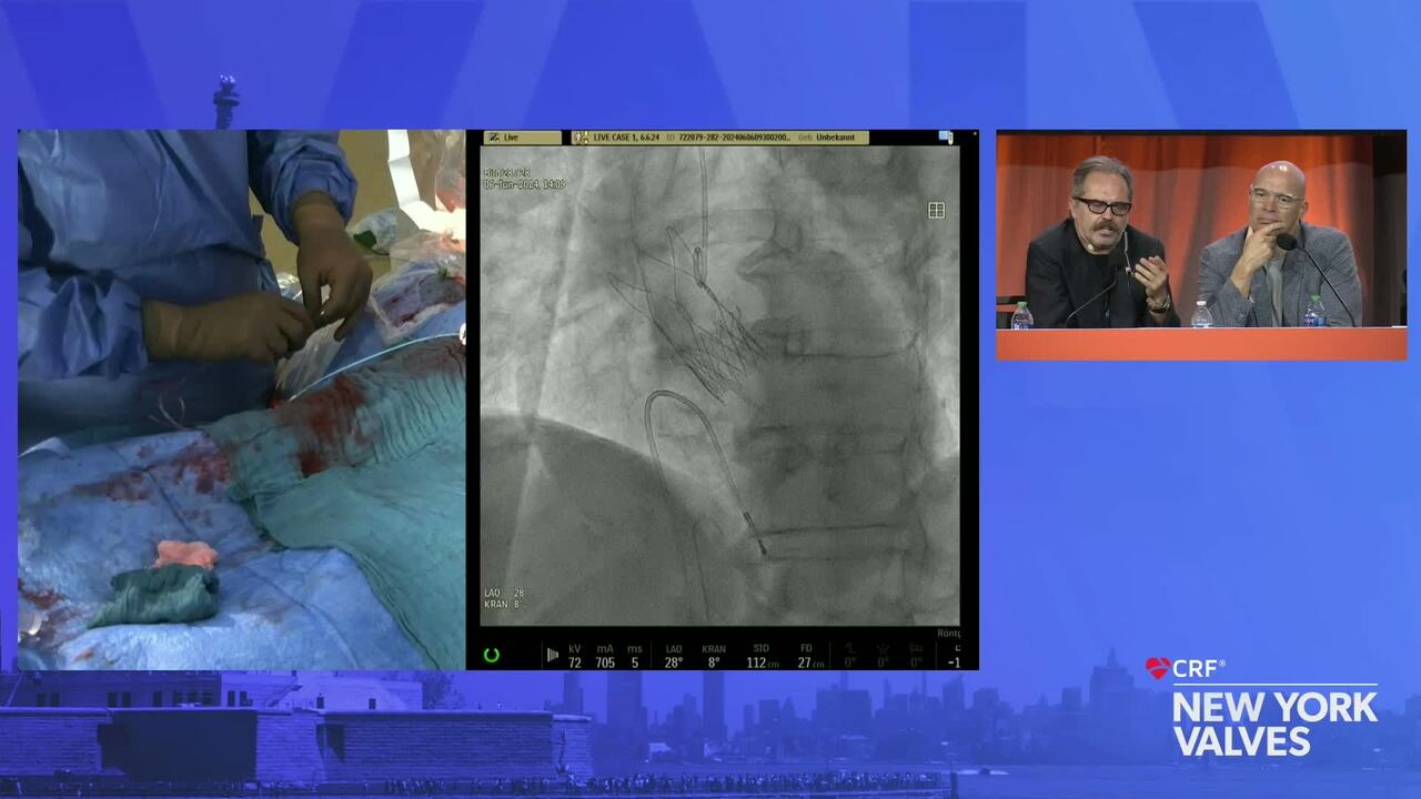 LIVE Case: New  TAVR - The Heart Center Leipzig, University Hospital, Leipzig, Germany