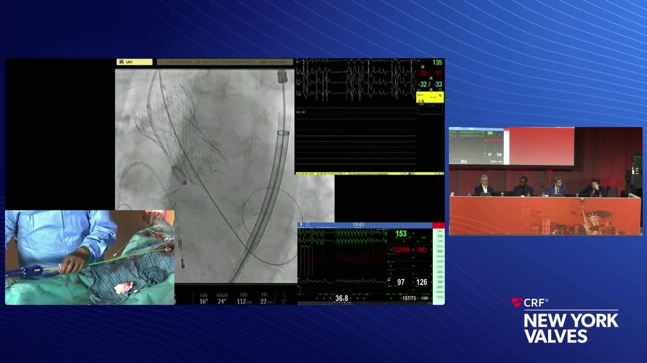 Live Case 8- Bicuspid AS-TAVR and Surgery_LIVE Case Presentation 2- Leipzig Heart, Leipzig, Germany-