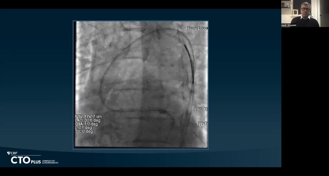Rotablation and Cutting Balloon to Release Stuck Externalized RG3 in an Ostial RCA Occluded 1st Generation DES