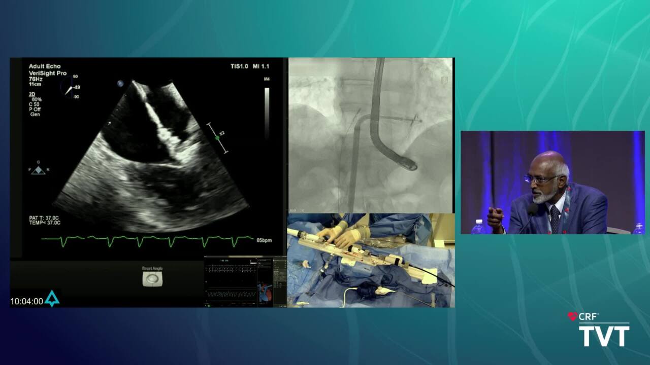 Live Case 2: PASCAL Tricuspid TEER (CLASP II TR) - NYP-CUMC - New York, NY