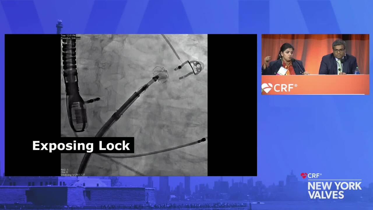 Live Case: LAAO New Devices - St. Bernards Med Center, Jonesboro, Arkansas
