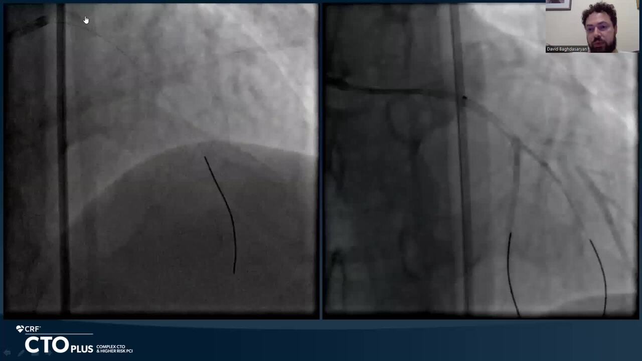Electrophysiological Procedure Complicated by Coronary Dissection