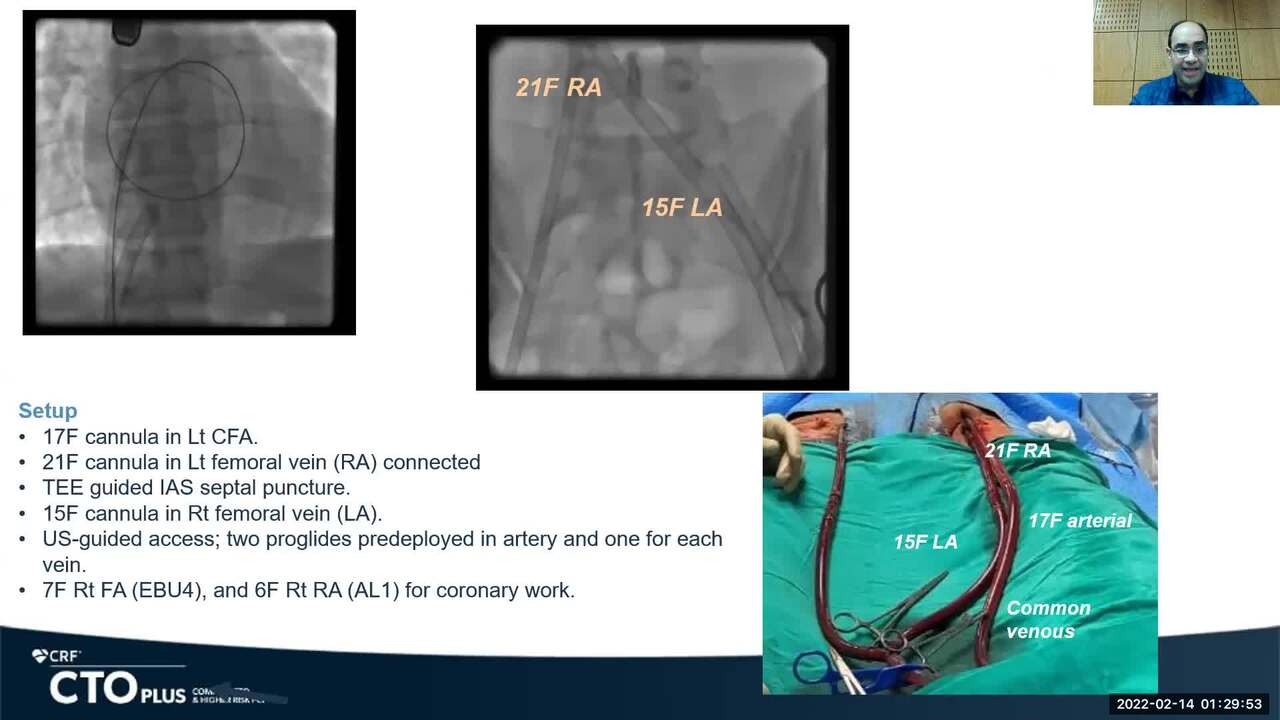 Protected Three Vessel CTO PCI on a Budget