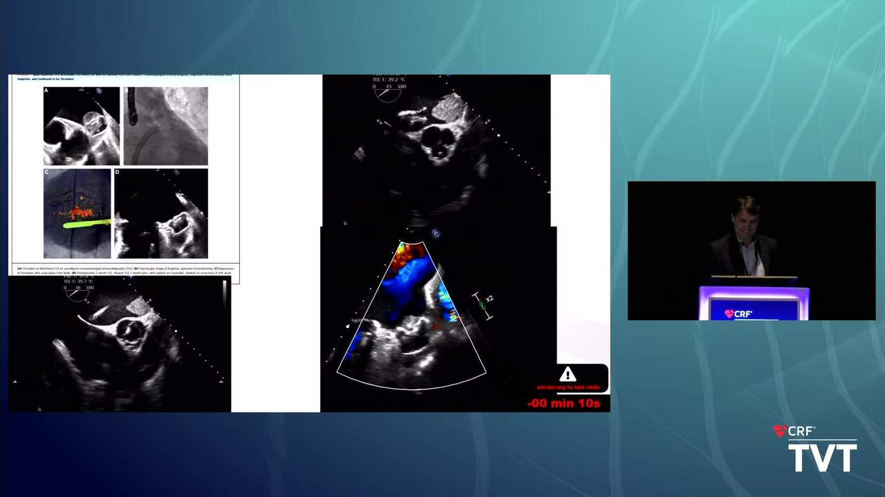 SPOTLIGHT LECTURE: Smoke Versus Fire: Different Approaches to Handling LAA Thrombus