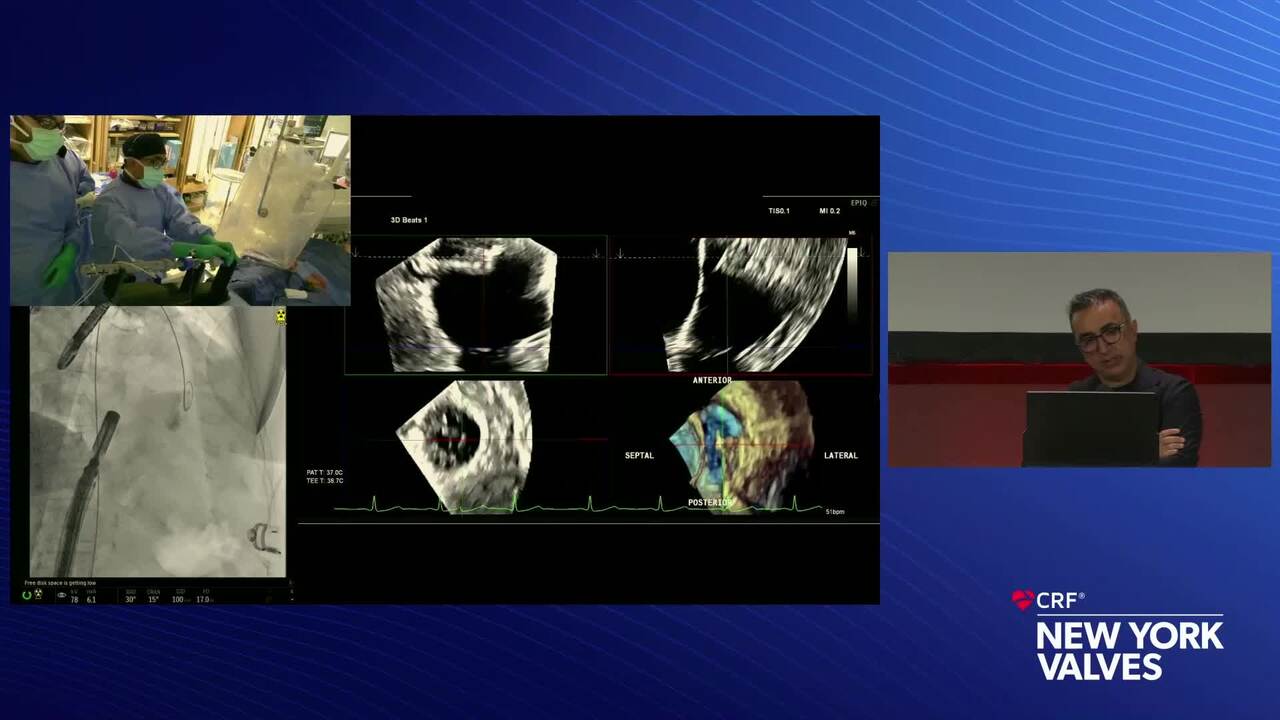 Live Pre-Recorded Case Presentation 1: TTVR (Intrepid) - Montefiore Medical Center, New York, NY