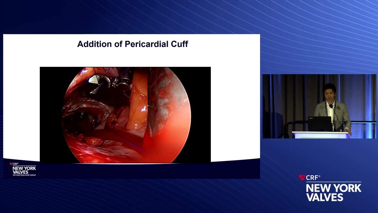 Surgery in MAC: Indication, Emerging Techniques and Outcomes