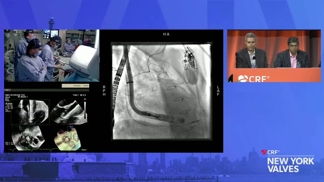 Live Case: LUX Tricuspid Valve Replacement – St. Michael's Hospital, Toronto, Canada