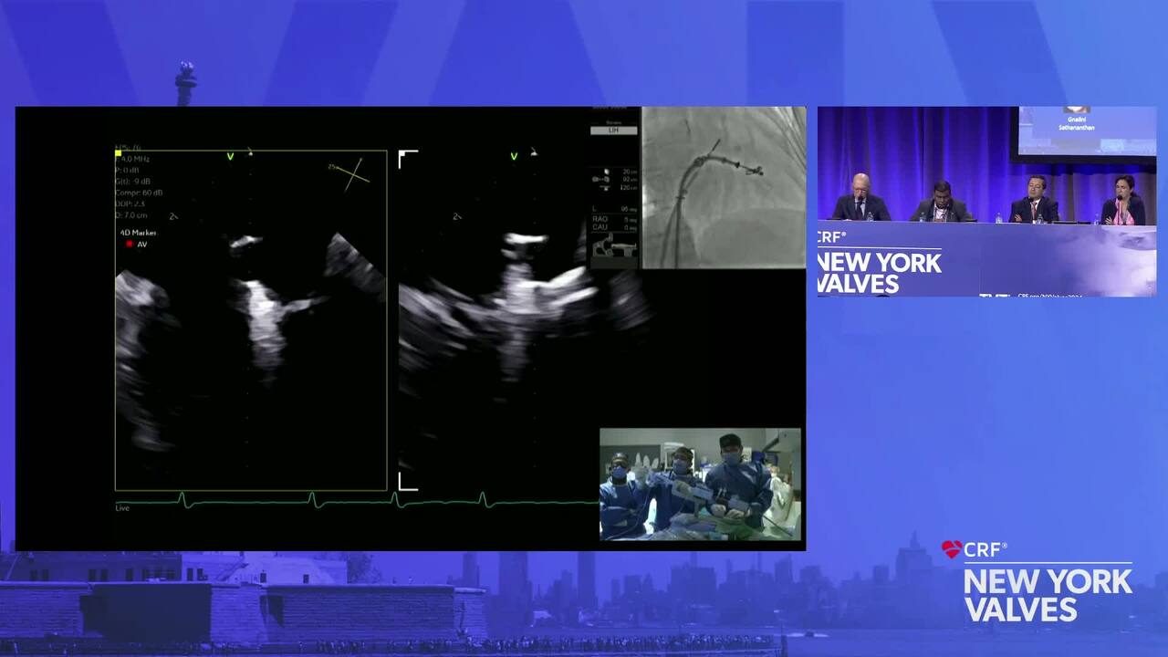 LIVE Case: Mitral-TEER for Primary MR – St. Paul's Hospital, Vancouver, CA