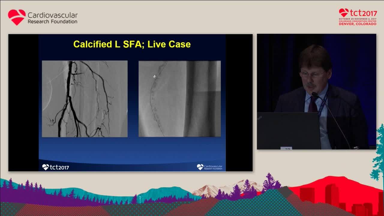 SFA Atherectomy for Complex Calcified Lesions: Case Examples and Data ...