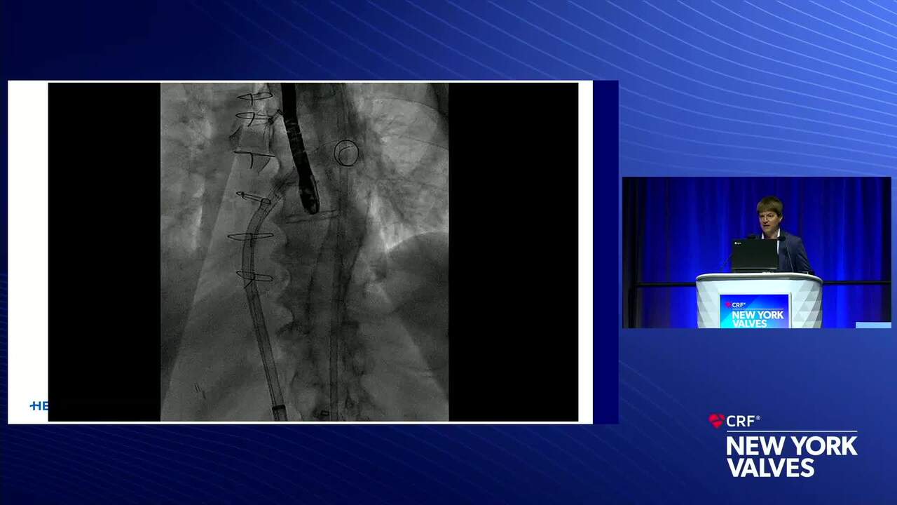 LAAC in the Presence of Thrombus: When OAC Fails