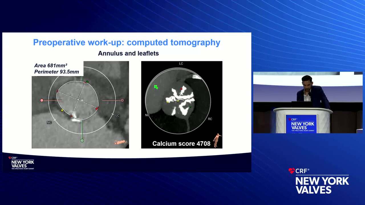 Case Presentation: A Young Low-Risk Patient With Symptomatic Severe Tri-Leaflet Aortic Stenosis