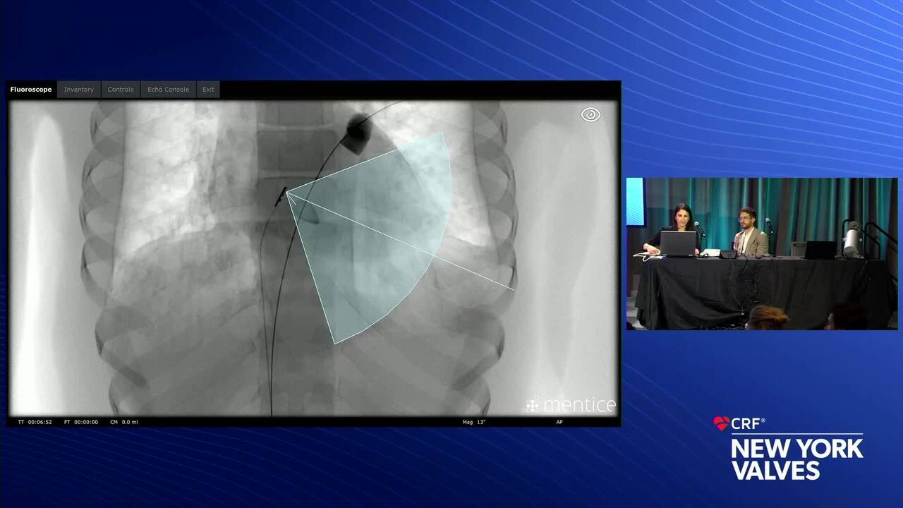 3D ICE Simulation: Essential Views and Catheter Position