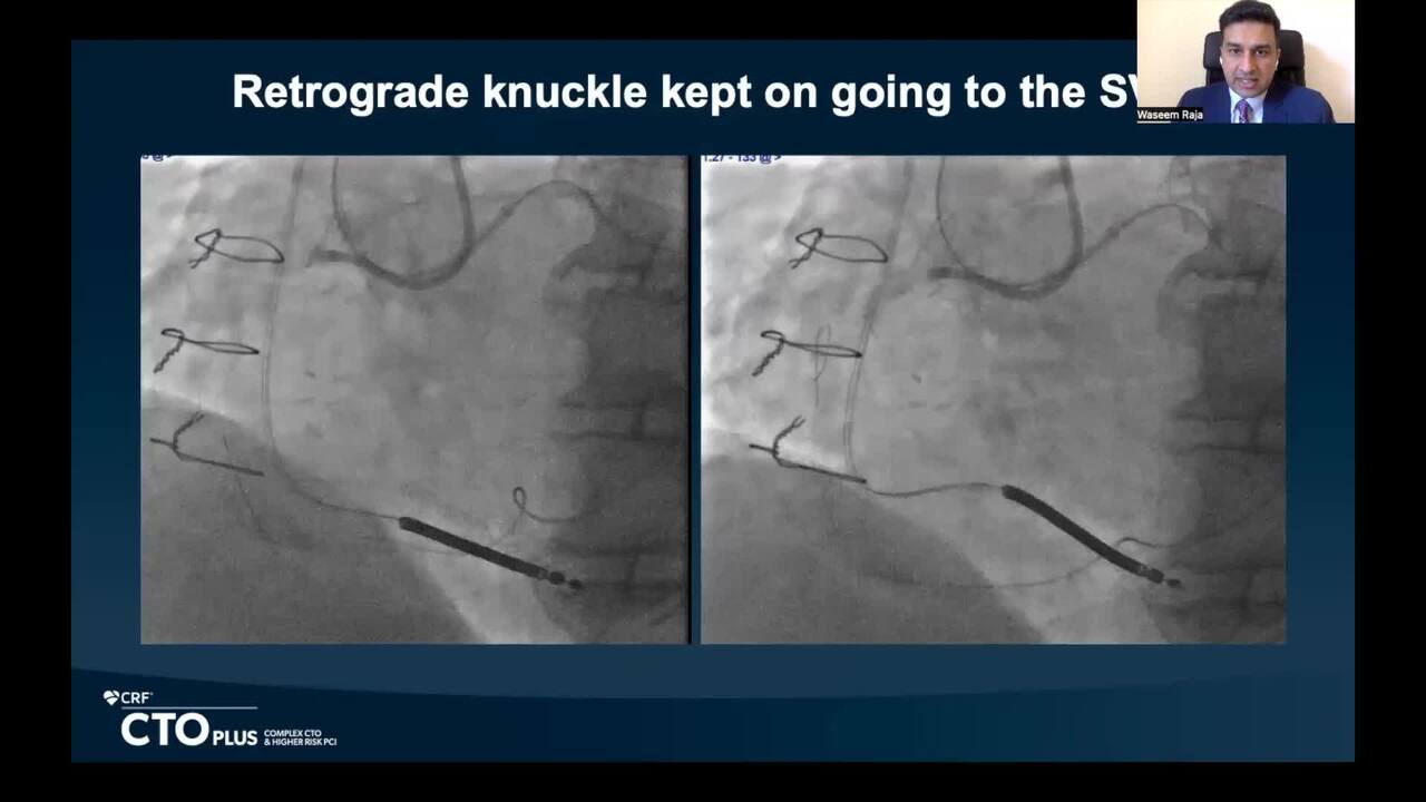 A Complex Retrograde CTO PCI of RCA Demonstrating Difficulty Posed by Occluded SVG at the Distal Cap and Troubleshooting the Reverse-CARTA Complex Retrograde CTO PCI of RCA Demonstrating Difficulty Posed by Occluded SVG at the Distal Cap and Troubleshooting the Reverse-CART