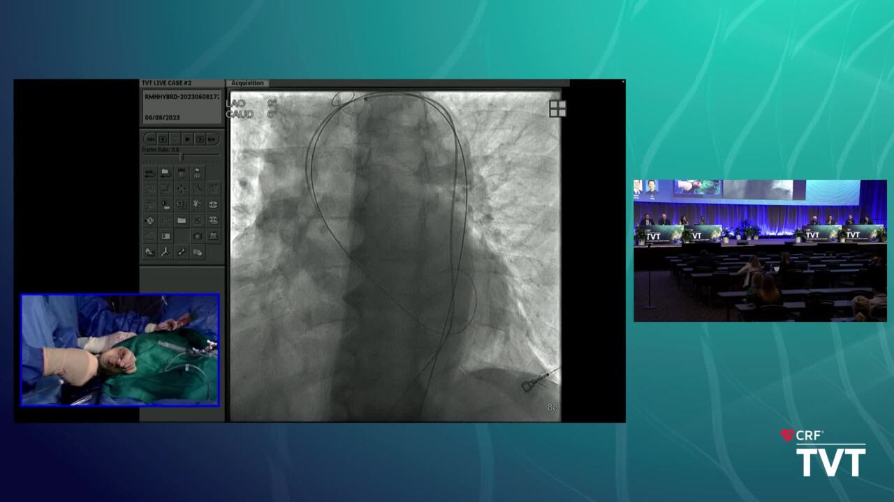 LIVE Case 8: ACURATE Prime XL TAVR Large Annulus - Ohio Health - Columbus, OH