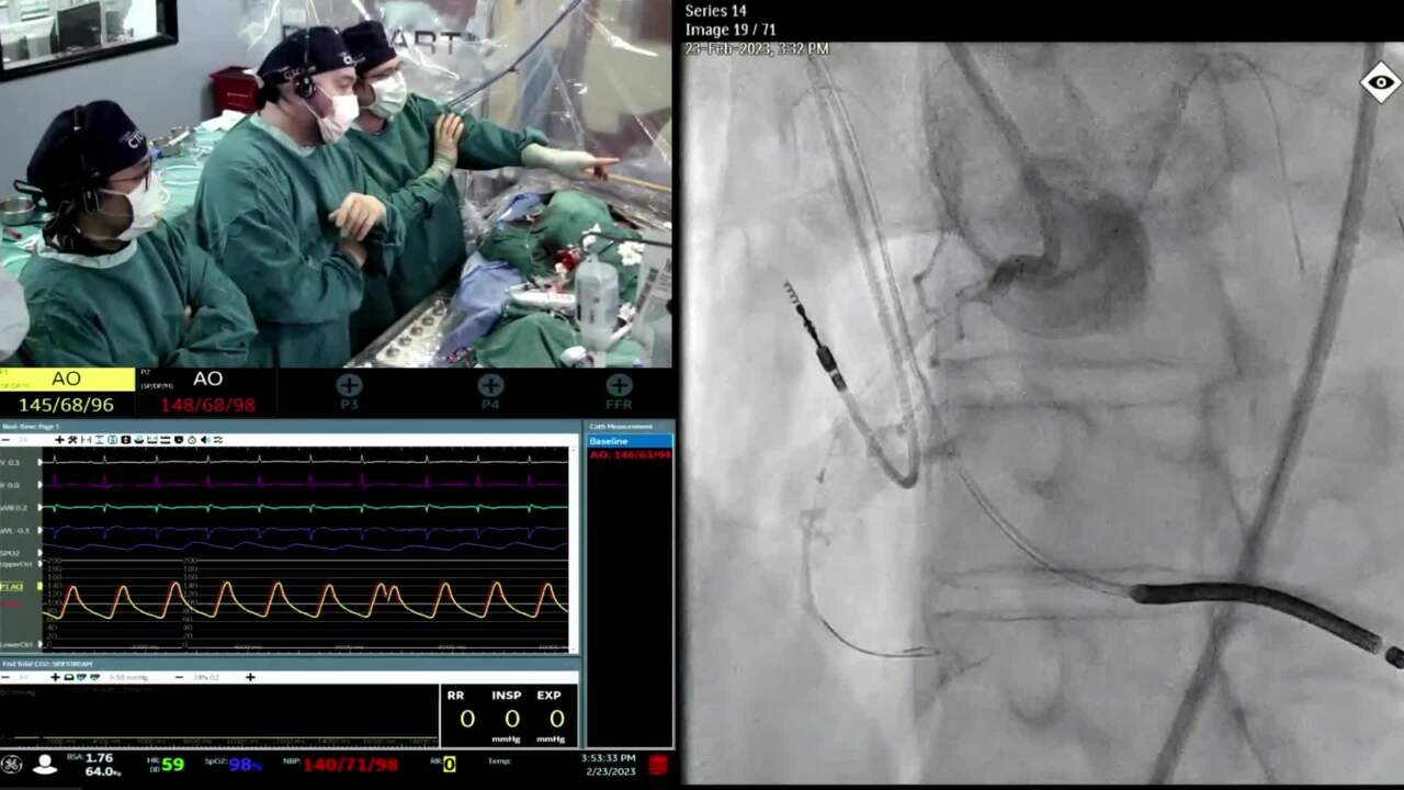 




RCA CTO Ipselateral Collateral


