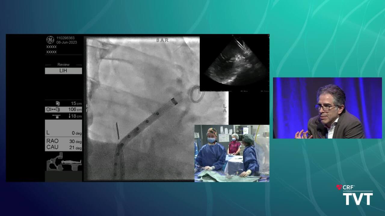 LIVE Case 10: AMULET LAAO Steerable Guide - FEOPS Planning - St. Paul&#039;s Hospital, Vancouver